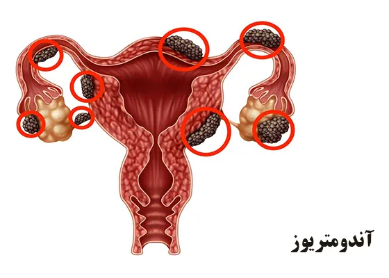 آندومتریوز