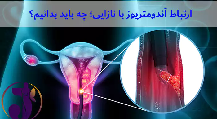 ارتباط آندومتریوز با نازایی؛ چه باید بدانیم؟
