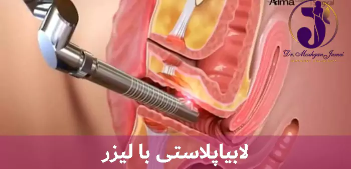 لابیاپلاستی با لیزر