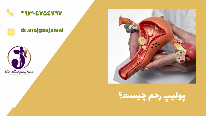 پولیپ رحم چیست؟