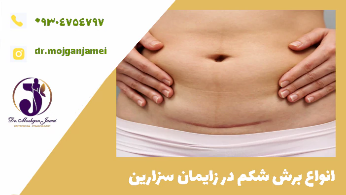 انواع برش شکم در زایمان سزارین 