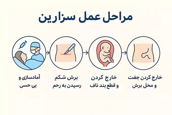 اینفوگرافیک  مراحل عمل سزارین