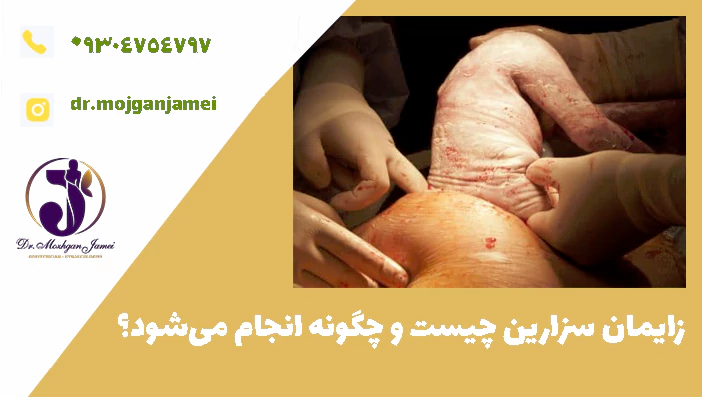 زایمان سزارین چیست و چگونه انجام می‌شود؟