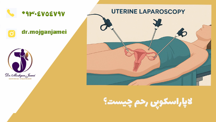 لاپاراسکوپی رحم