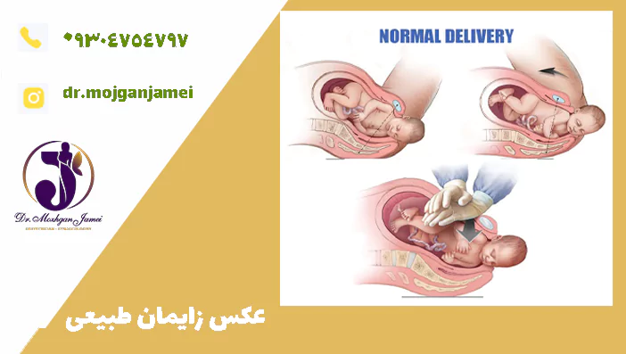 عکس زایمان طبیعی