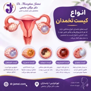 آشنایی با انواع کیست تخمدان